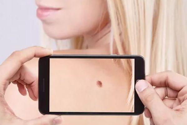 Мобильное приложение, определяющее рак кожи разработали в Нижнем Новгороде