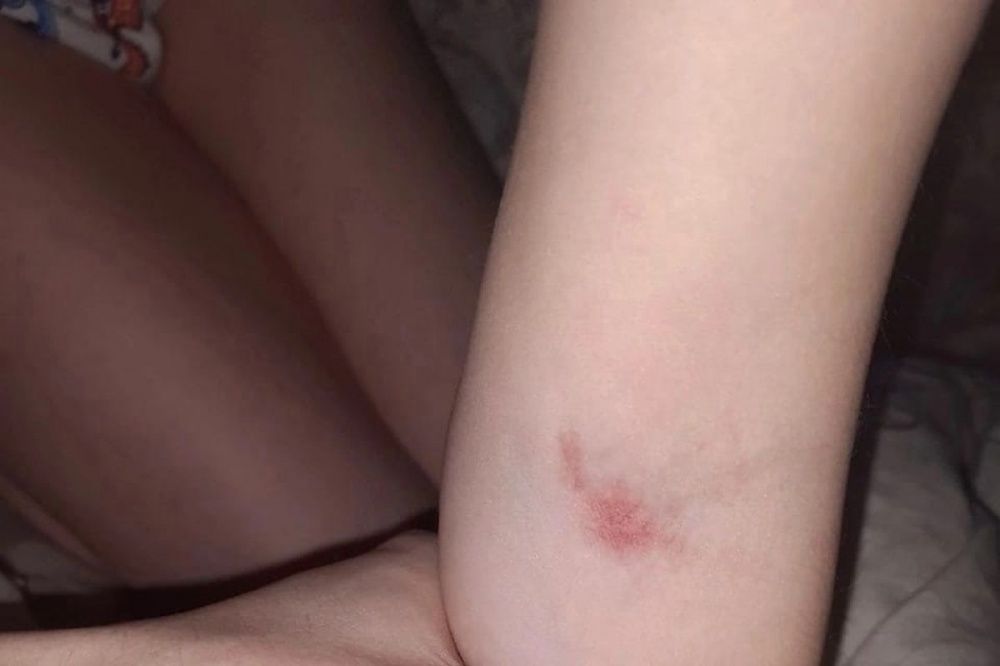 6-летний житель Дзержинска покрылся болячками из-за плесени в квартире