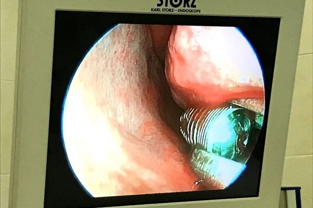 Нижегородские врачи извлекли зубной имплант из пазухи носа у пациента
