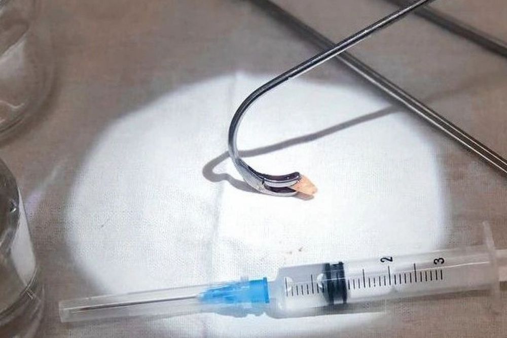Фото Корень зуба удалили из носовой пазухи у жительницы Нижнего Новгорода - Новости Живем в Нижнем