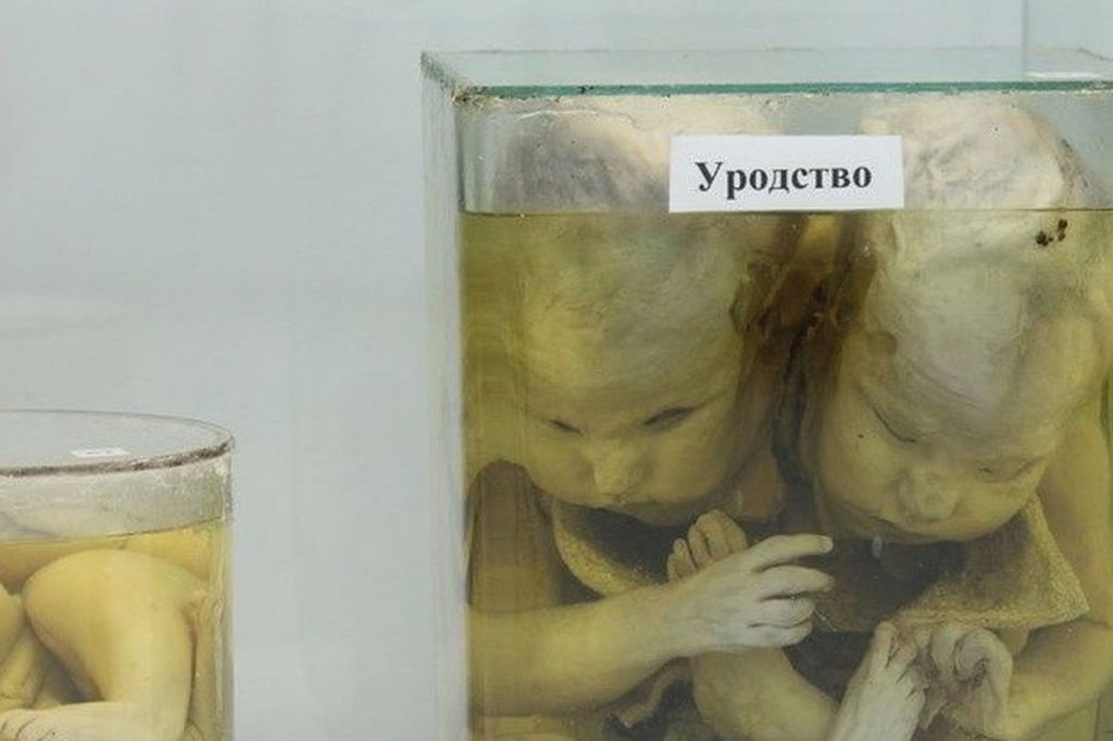 Не рождённые сиамские близнецы - экспонат музея кафедры патанатомии нижегородского ПИМУ.