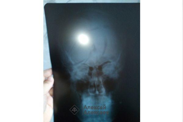Рентген головы ребенка, которому прострелили щеку из пневматического пистолета в Дзержинске Нижегородской области