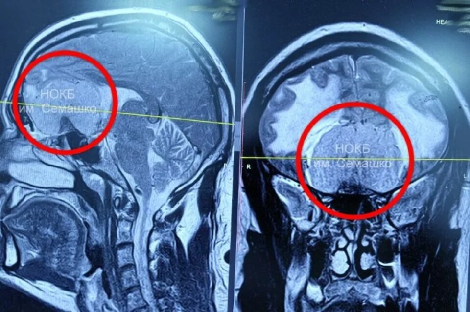 Фото Нижегородские врачи удалили у пациента гигантскую опухоль мозга  - Новости Живем в Нижнем